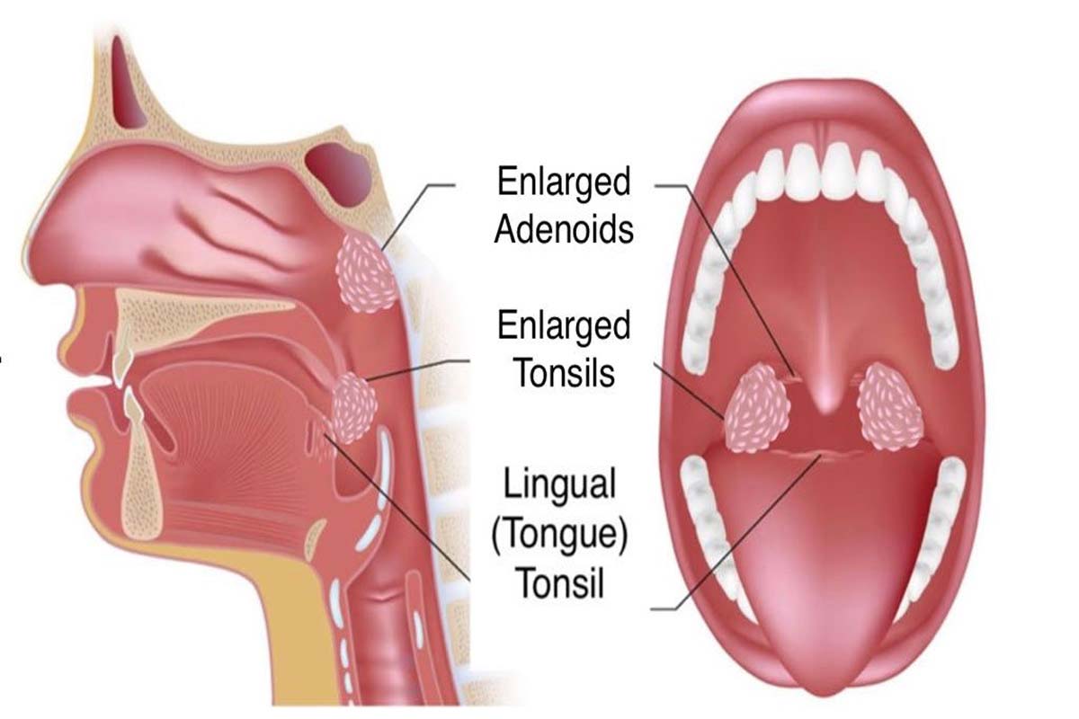 Throat Surgery