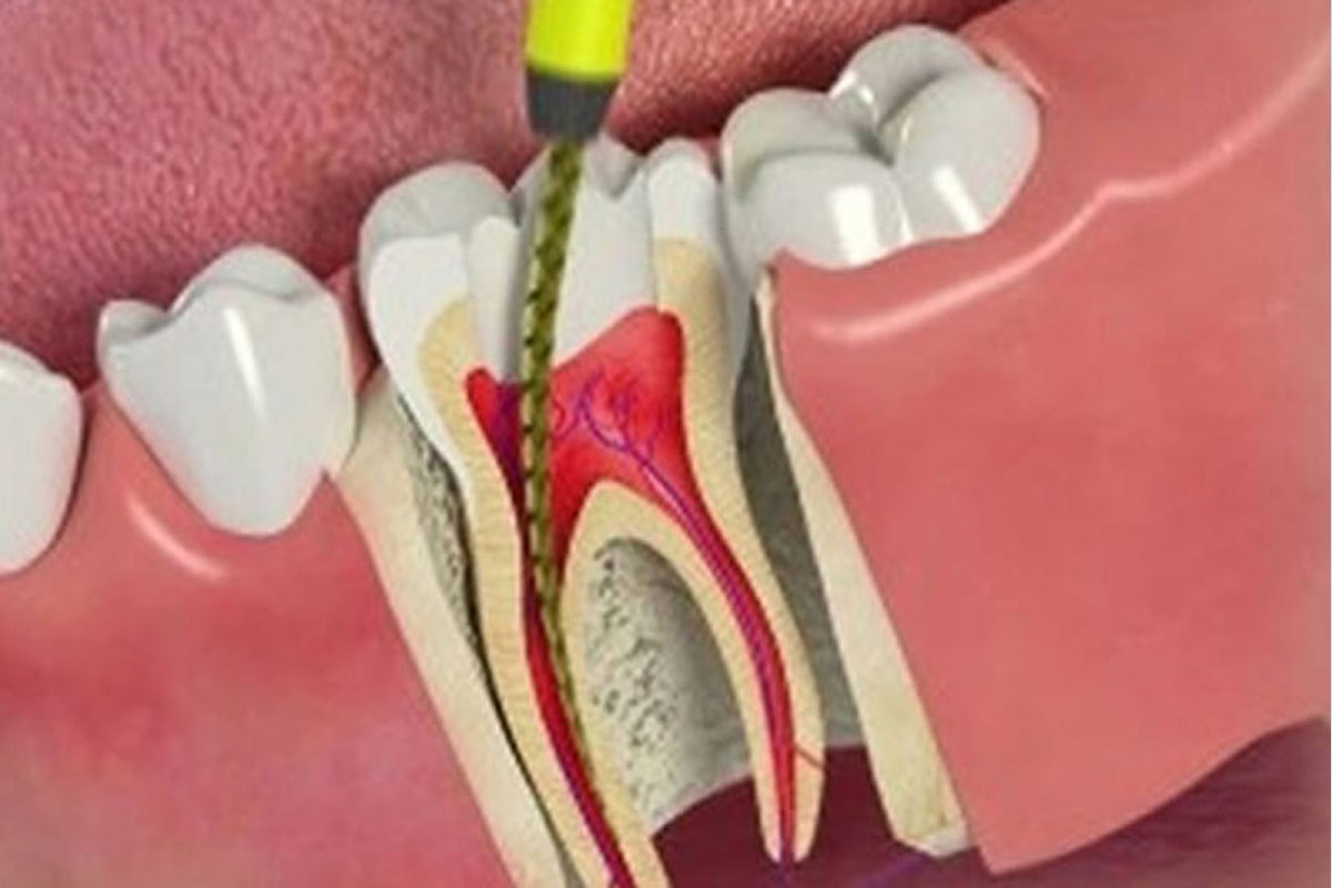 Root Canal Treatment(RCT)