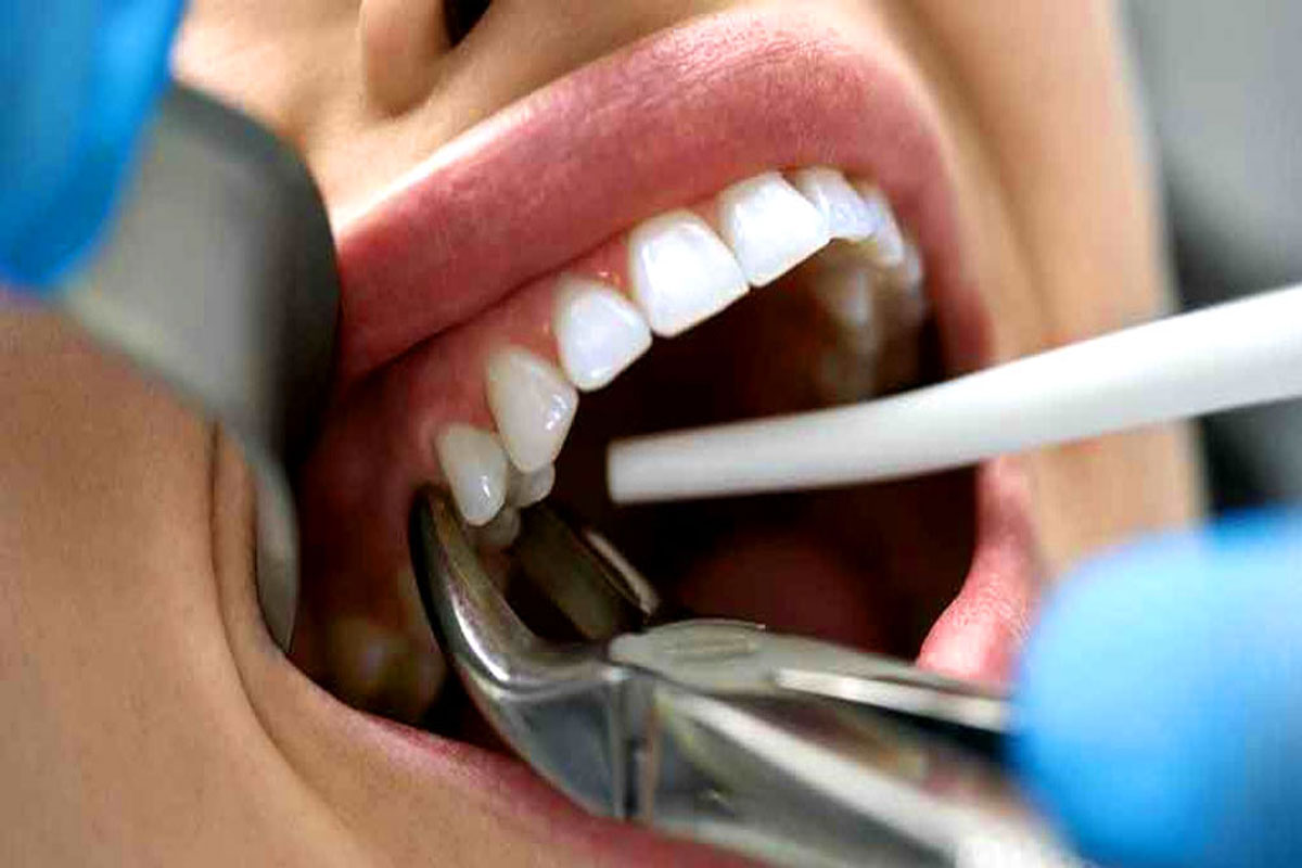 Painless Tooth Extraction