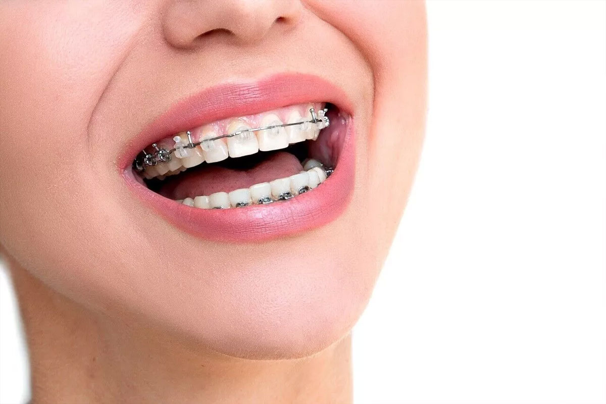 Teeth Alignment – Orthodontics