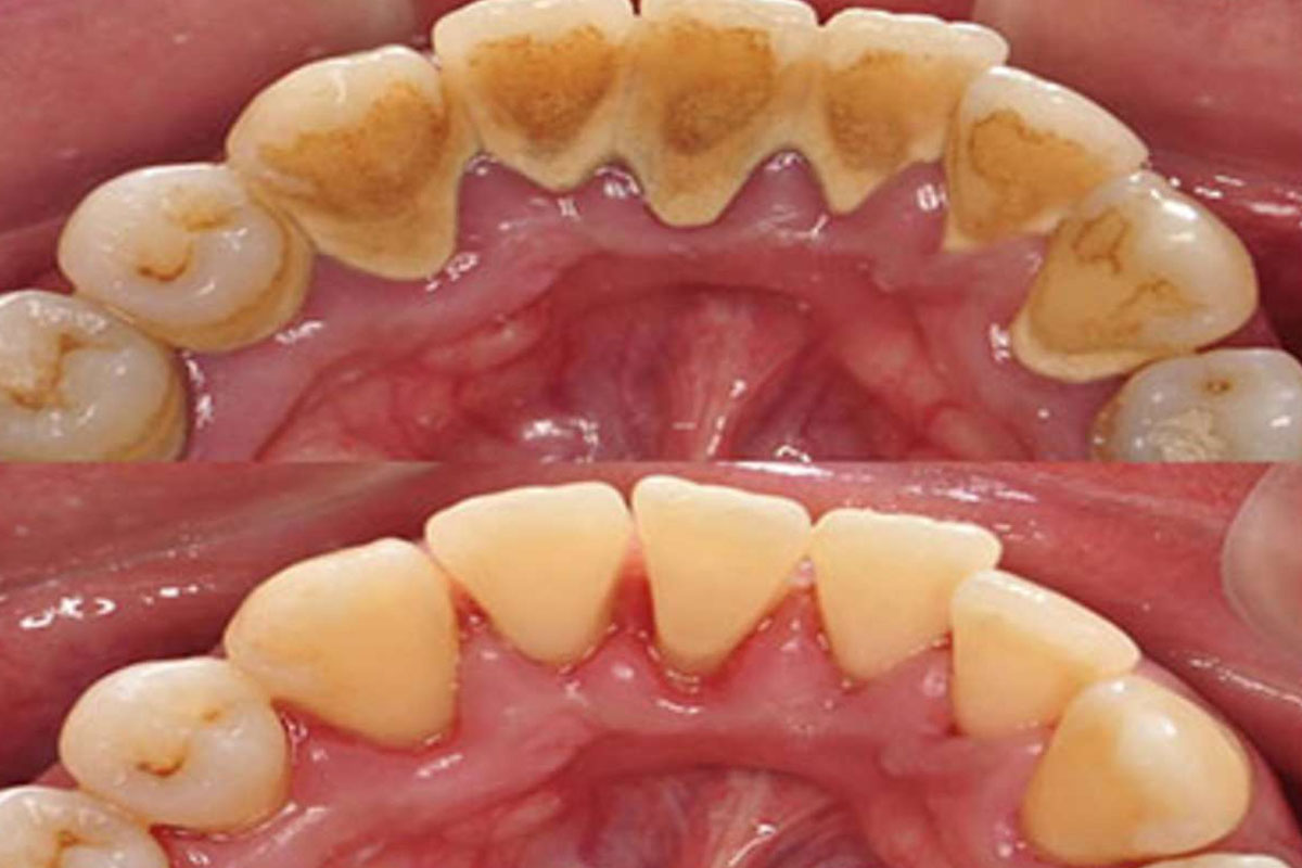 Treatment of Periodontal Problems
